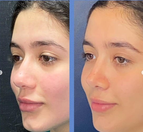 Rinoplastia caso 22 — antes y después